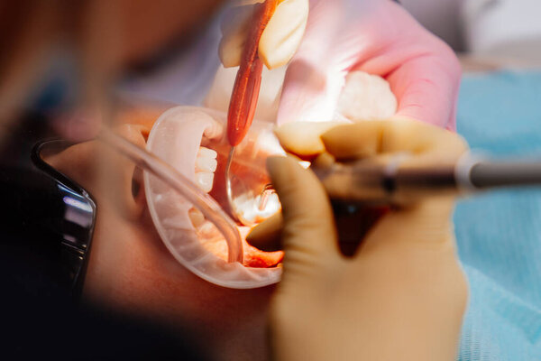 Настоящий. стоматолог лечит пациента кариесом, сверлит зуб и устанавливает наполнение