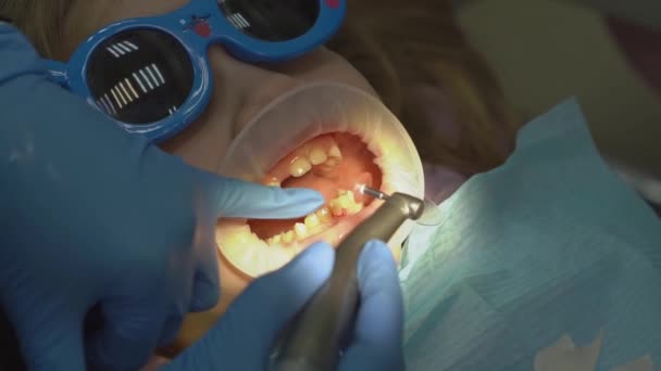 Egy kislány szájtágítóval a fogorvosnál. fogpolírozás — Stock videók