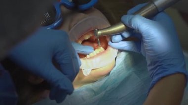 Dişçi randevusunda ağız genişleticisi olan küçük bir kız. Dişlerin parlatılması