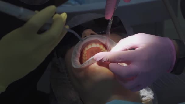 Настоящий. стоматолог лечит пациента кариесом, сверлит зуб и устанавливает наполнение — стоковое видео