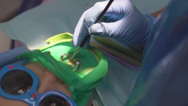 Tandläkare använder Cofferdam för behandling karies och tand rekonstruktion av ett barn — Stockvideo