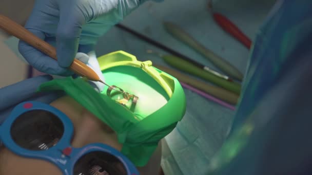 Zubař používá Cofferdam pro ošetření zubů a rekonstrukci zubů dítěte — Stock video