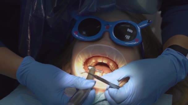 Dişçi randevusunda ağız genişleticisi olan küçük bir kız. Dişlerin parlatılması — Stok video