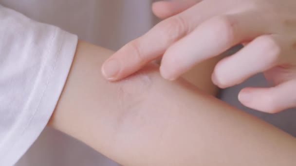 Μαμά εφαρμόζει την αλοιφή στην δερματίτιδα στην κάμψη του αγκώνα σε ένα μικρό κορίτσι — Αρχείο Βίντεο