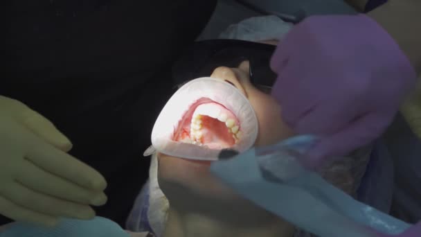 Echt waar. tandarts trekt een zieke verstandskies. — Stockvideo