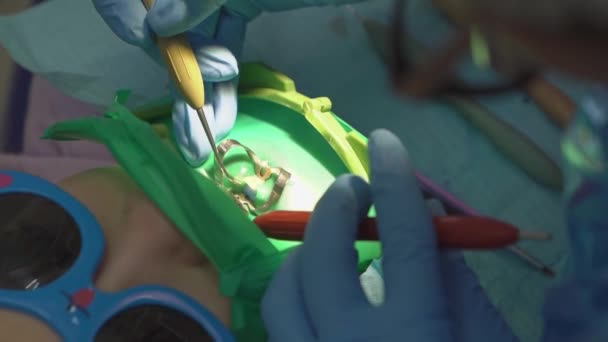 Zubař používá Cofferdam pro ošetření zubů a rekonstrukci zubů dítěte — Stock video