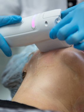 Cerrahi olmayan yüz kaldırma. SMAS ultrasonik kaldırıyor. Yenilenme süreci. Donanım kozmetolojisi. yüz plastiği. Cildiyeci doktor, beyaz bir kadını ultrasonla yüz gerdirme ameliyatı yaptı.