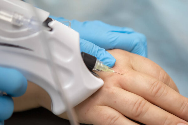 Врач вводит углекислый газ с помощью иглоукалывателя в кожу рук пациентов. Карбоксиотерапия. Лечение и омоложение кожи рук. Синдром туннеля, сухая кожа