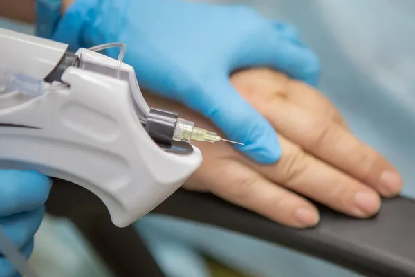El médico inyecta dióxido de carbono utilizando una máquina de agujas en la piel de la mano de los pacientes. Carboxiterapia. Tratamiento y rejuvenecimiento de la piel de las manos. Síndrome del túnel, piel seca de la Imágenes De Stock Sin Royalties Gratis
