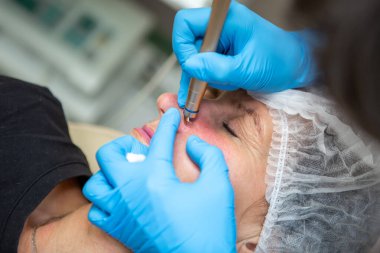 Beyaz bir kadının yüzünde kırmızı lekeler, rosacea, kan damarları çıkarılmış. Lazer aygıtı. 