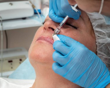 Dudak büyütme, dudak düzeltme, hyaluronik asit hazırlama. Beyaz bir kadın.