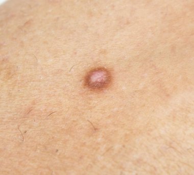 Hemosiderotic dermatofibroma on  scar on the skin