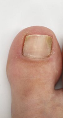 Big toe nail of a person suffering from onychomycosis, a fungal infection that causes yellowing of the nail