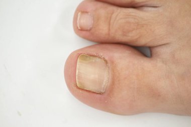 Big toe nail of a person suffering from onychomycosis, a fungal infection that causes yellowing of the nail