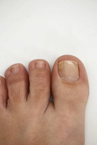 Big toe nail of a person suffering from onychomycosis, a fungal infection that causes yellowing of the nail