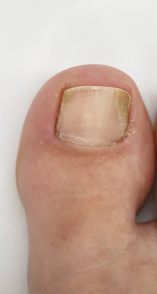 Big Toe Nail Person Suffering Onychomycosis Fungal Infection Causes Yellowing — Stock Photo, Image