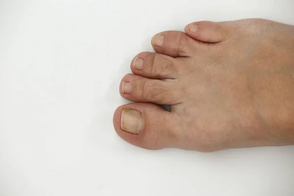 Big Toe Nail Person Suffering Onychomycosis Fungal Infection Causes Yellowing — Zdjęcie stockowe