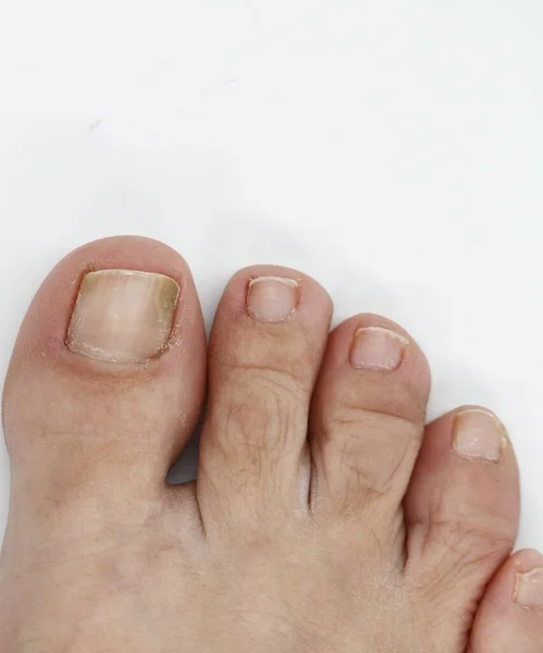 Big toe nail of a person suffering from onychomycosis, a fungal infection that causes yellowing of the nail