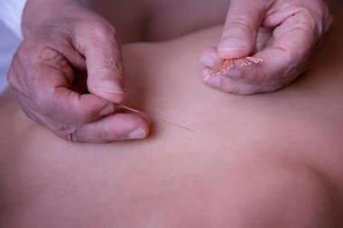Akapunkturcu doktor tıp yatağında yatan hastanın derisine iğne uygular.