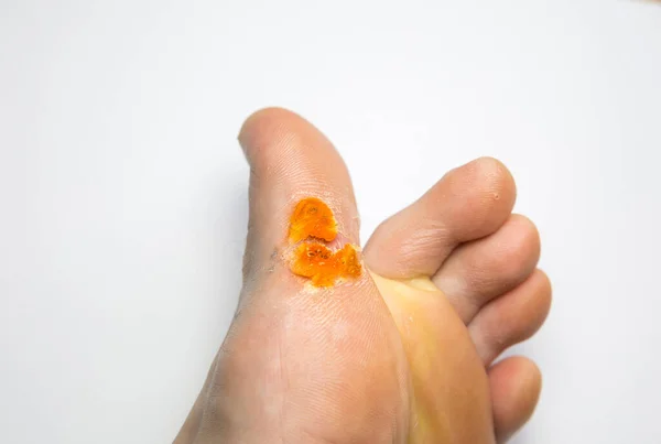 Contagious Skin Illness Foot Medical Treatment Photo — Stock Photo, Image