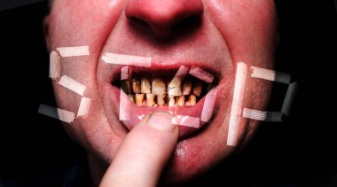 Adamın ağzında diş çürükleri ve paradontosis var. Diş çürümesi problemleri ve kötü bir gülümseme. Dişçi tedavisi konsepti. Dur işareti.