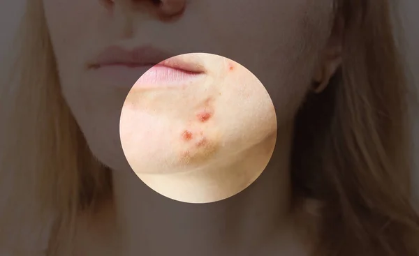 Piel Grasa Mujer Con Problemas Acné Cicatrices Heridas Cara Salud — Foto de Stock