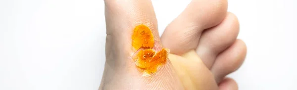 Contagious Skin Illness Foot Medical Treatment Photo — Stock Photo, Image