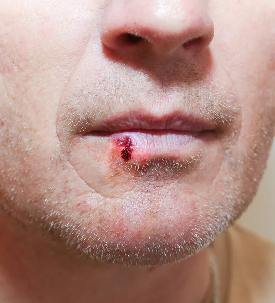 Herpes Infection Lips Wound Blood Man Face Medical Care Photo — Stock fotografie