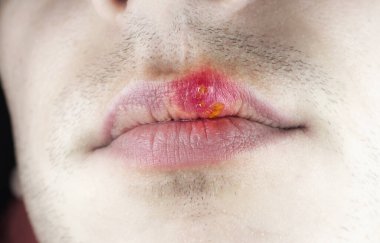 Kafkasyalı bir adamın dudağında uçuk dudağı. Yüzü yakın çekim