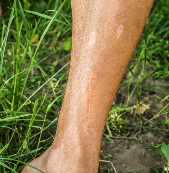 Vecchia Cicatrice Sulla Gamba Dell Uomo Incidente Passato — Foto Stock