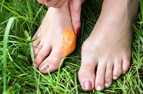 Bunion on the woman\'s foot. Woman is applying cream on big toe.