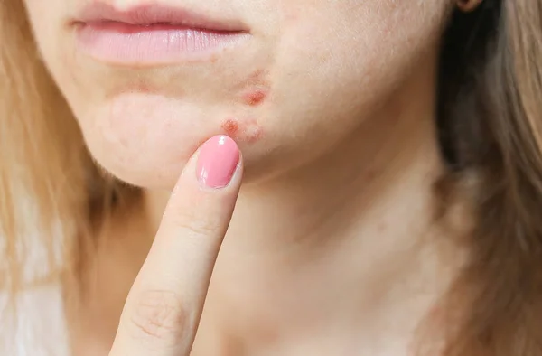 Woman\'s oily skin with acne problems. Scars and wounds on the face. Health care photo.