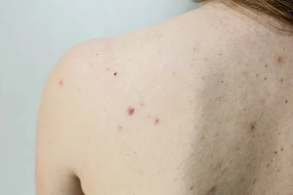 Many birthmarks on the girl's back. Medical health photo. Woman's oily skin with problems acne.