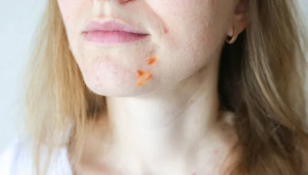 Woman's oily skin with acne problems. Scars and wounds on the face. Health care photo.