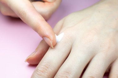 Woman applying hands cream. Irritated, problem skin of hands. Dermatology concept. Close up.