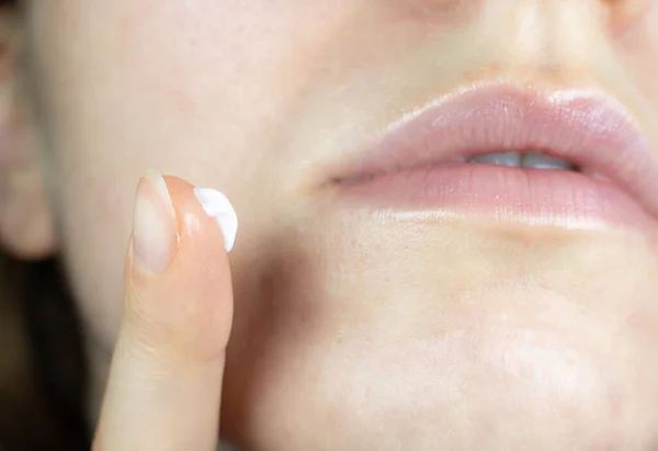 Woman Applying Face Cream Irritated Problem Skin Hands Dermatology Concept — Fotografia de Stock