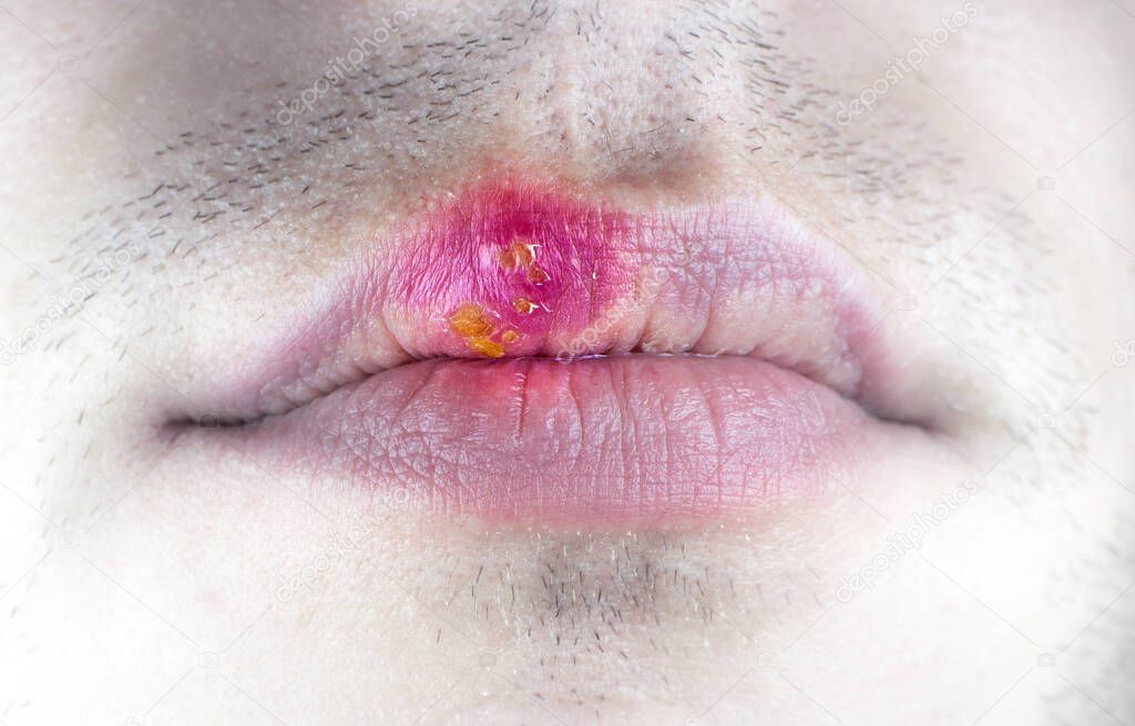 Herpes labialis on the lip of a Caucasian man. Face close-up