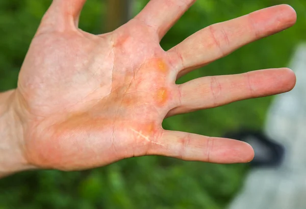 Old scar on man\'s hand. Accident in the past.