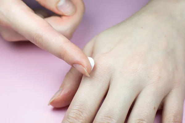 Mulher Aplicando Creme Mãos Irritado Pele Problema Mãos Conceito Dermatologia — Fotografia de Stock