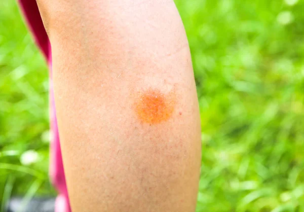 Mosquito Bite Leg Insects Summer Dangerous Nature Itchy Body — Foto Stock