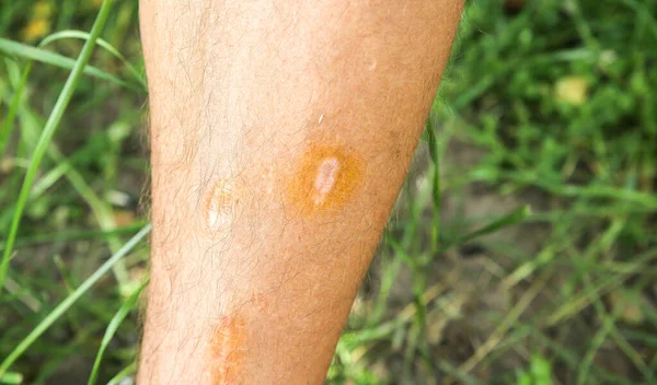 Uma Cicatriz Velha Perna Homem Acidente Passado — Fotografia de Stock