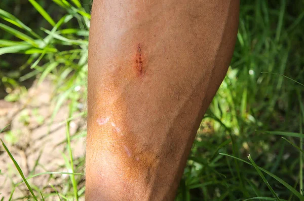 Old scar on man\'s leg. Accident in the past.