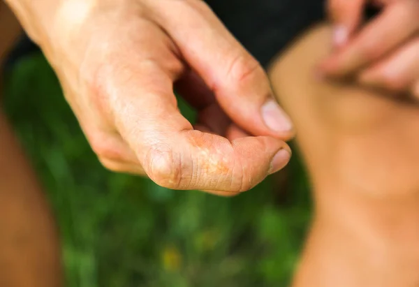 Old Scar Man Finger Accident — Stock Photo, Image