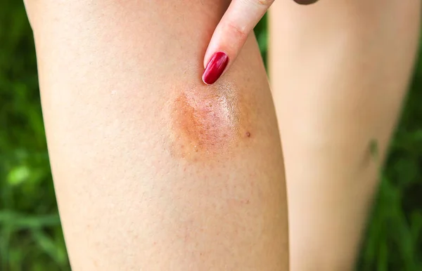 Komáří Kousnutí Nohy Létě Hmyz Nebezpečná Povaha Svědí Tělo Dívka — Stock fotografie