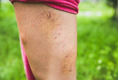 Mosquito bite on the leg. Insects in the summer. Dangerous nature. Itchy body. Varicosity on skin.