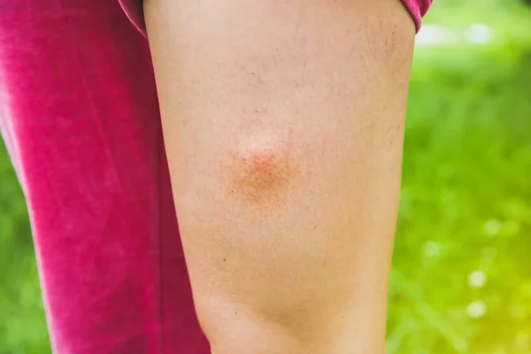 Комариный Укус Ноге Насекомые Летом Опасная Природа Зудящее Тело — стоковое фото