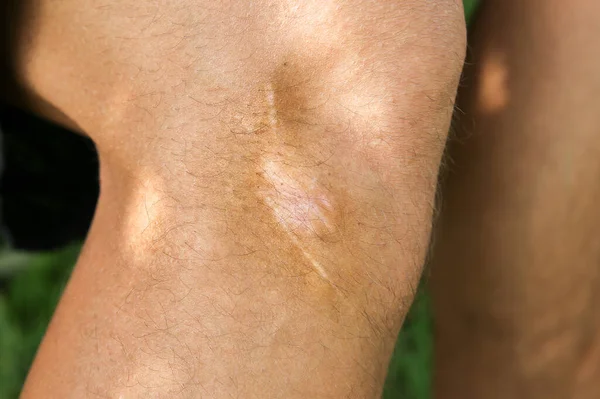 Old scar on man\'s leg. Accident in the past.