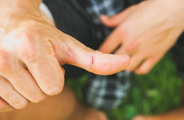 Fresh wound on man\'s finger. Accident with a cut on skin.