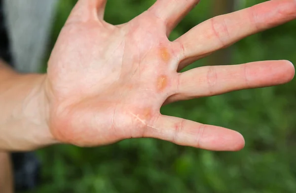 Old scar on man\'s hand. Accident in the past.