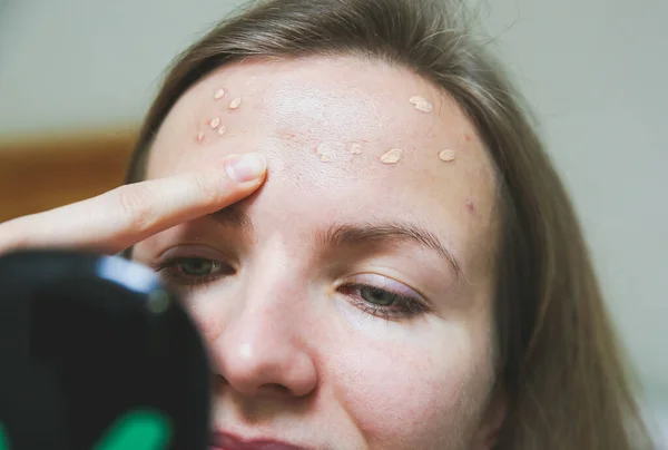 Mulher Está Cobrindo Acne Com Corretor Maquiagem Para Pele Oleosa — Fotografia de Stock